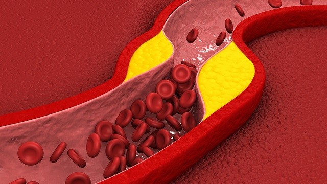 혈관이 막히며 증상이 나타나기 전까지, 이상지질혈증은 별다른 증상이 나타나지 않는다｜출처: 게티이미지뱅크