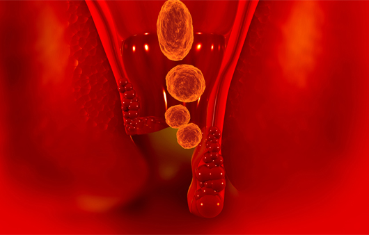 치핵ㅣ출처: 게티이미지뱅크
