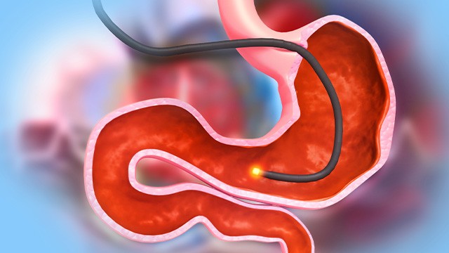 위내시경은 위암을 비롯한 위장질환을 조기에 발견할 수 있는 가장 효과적인 검사법이다 |출처: 게티이미지뱅크