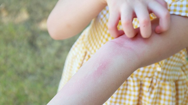 ﻿땀띠는 영유아에서 발생 위험이 높아 주의가 필요하다｜출처: 게티이미지뱅크