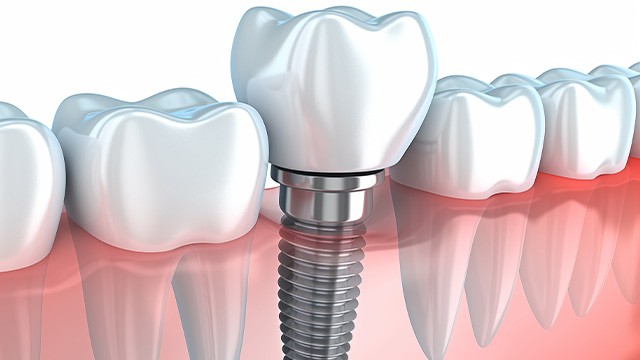 ﻿임플란트를 오래, 건강하게 사용하려면 숙련된 치과에서 올바르게 수술 받는 것이 중요하다｜출처: 게티이미지뱅크