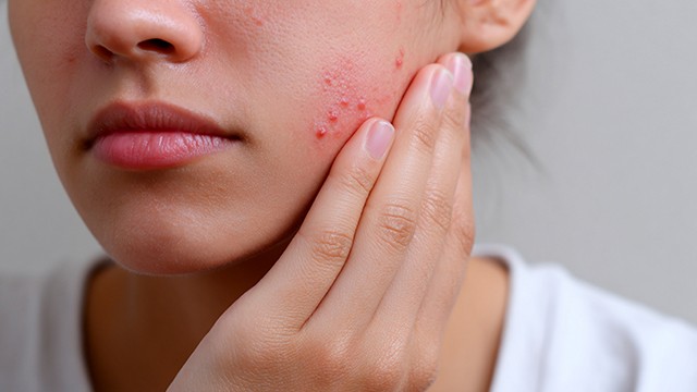 여드름은 여름철에 증상이 악화되기 쉽다｜출처: 클립아트코리아