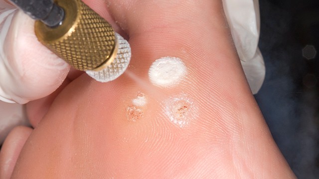 사마귀 바이러스를 효과적으로 치료하기 위해서는 면역력 개선이 필요하다|출처: 클립아트코리아