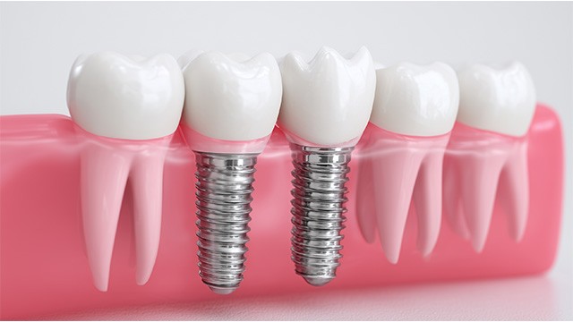 임플란트를 오랫동안 문제없이 사용하려면 적절한 관리가 필요하다|출처: 게티이미지뱅크