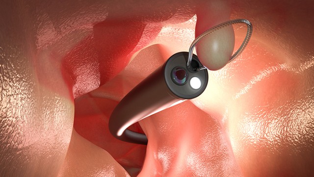 대장 용종을 제거 이력이 있다면 1~3년 간격으로 대장내시경 검사를 받는 것이 좋다┃출처: 게티이미지뱅크