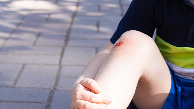 찰과상을 방치하면 세균 감염, 흉터로 이어질 수 있으므로 초기 관리가 중요하다|출처: 게티이미지뱅크