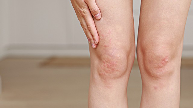 두드러기가 있다면 기름지고 자극적인 음식은 피하는 것이 좋다|출처: 클립아트코리아