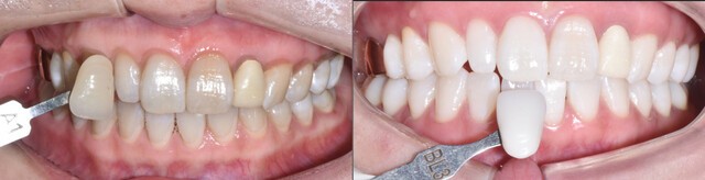 치아 미백|출처: 연세굿플란트치과의원