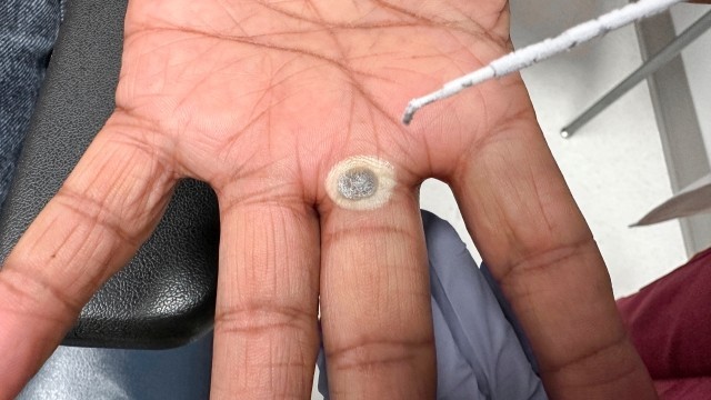 사마귀는 발병 초기 대응이 중요하다｜출처: 클립아트코리아