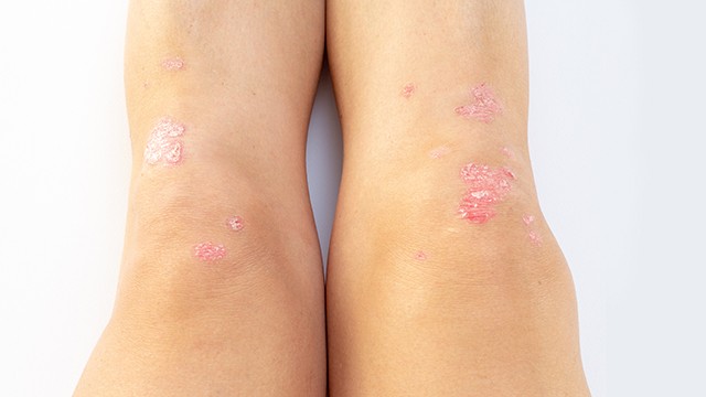 건선 피부염은 건조한 겨울철이나 스트레스가 심할 때 증상이 악화된다┃출처: 게티이미지뱅크