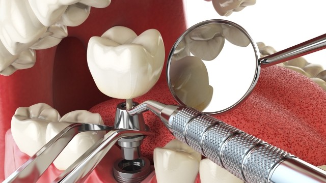 임플란트는 식립 후에도 꾸준한 관리가 필요하다｜출처: 클립아트코리아