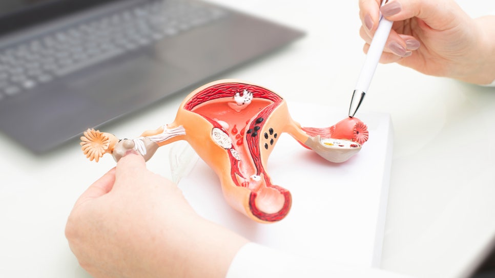 난소암은 초기 증상이 경미해 진단이 늦어지는 경우가 많다|출처: 클립아트코리아