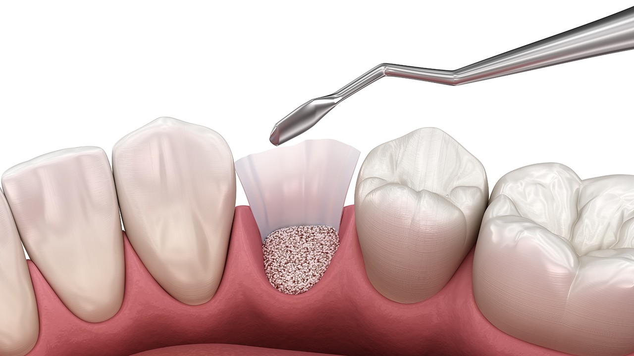 임플란트 뼈이식은 의료진의 풍부한 경험과 숙련도가 중요하다｜출처: 게티이미지뱅크