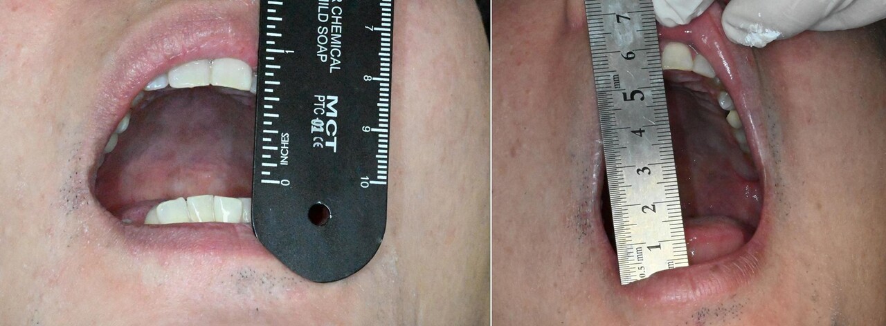 턱관절 통증 주사 시술 예시 | 출처: 림플란트치과의원