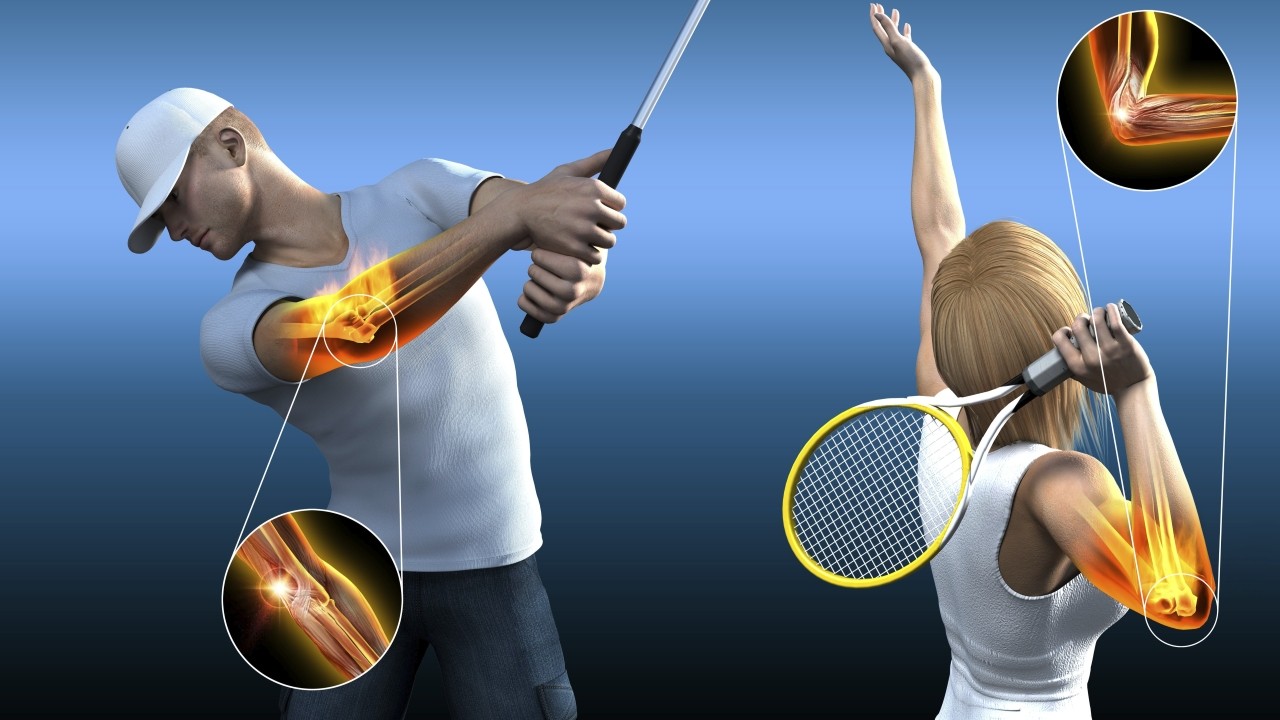 테니스, 골프 등 스포츠 활동을 하지 않아도 엘보 질환은 발생할 수 있다｜출처: 클립아트코리아