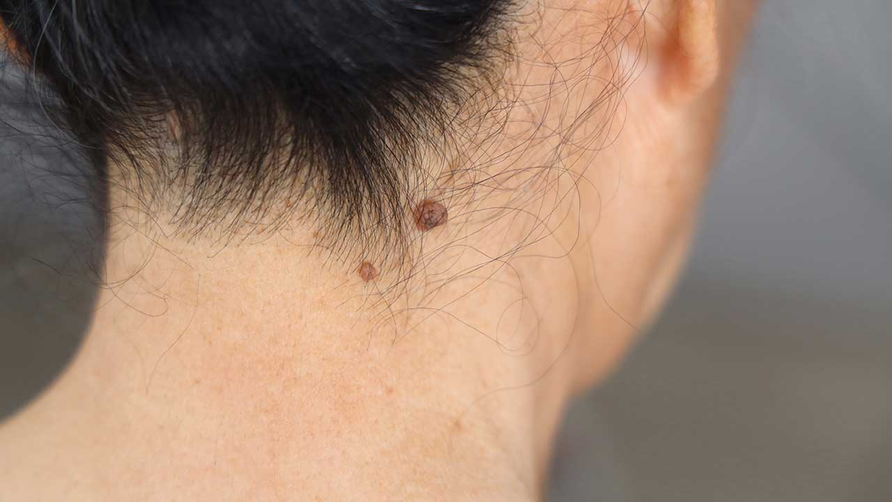 쥐젖이 생기는 이유, 쥐젖 실비보험, 쥐젖 제거방법, 연고