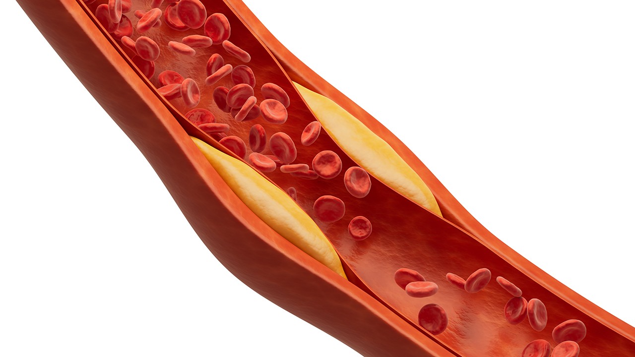 고혈압을 방치하면 혈관 내벽에 콜레스테롤과 지방이 쌓여 동맥경화로 이어질 수 있다｜출처: 게티이미지뱅크