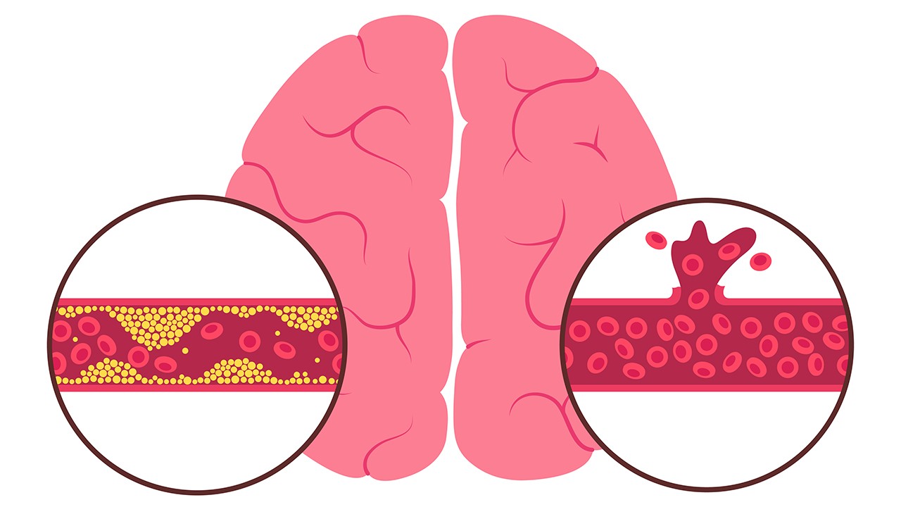 고혈압은 혈관이 막히는 뇌경색(좌), 약해진 혈관이 터지는 뇌출혈(우)을 일으킬 수 있다｜출처: 게티이미지뱅크