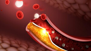 이상지질혈증(고지혈증) 관련 이미지